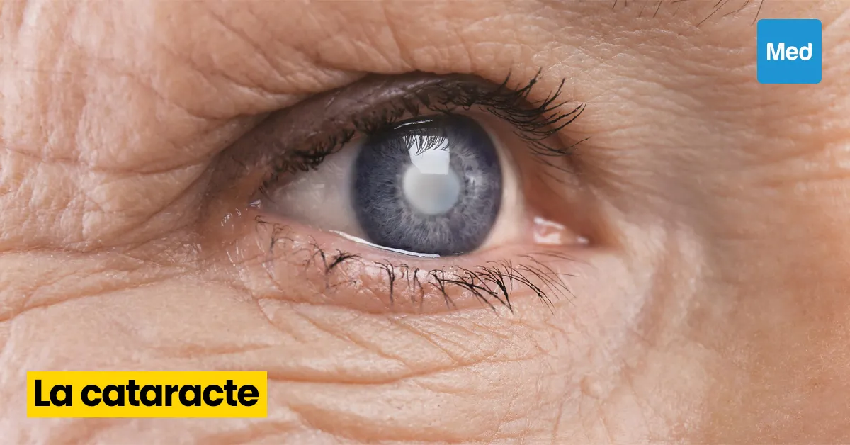 La cataracte : une maladie oculaire qui peut affecter la qualité de vie